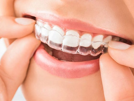 What are Invisible Braces?